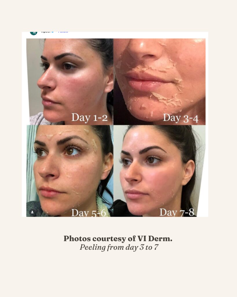 day by day peeling photo